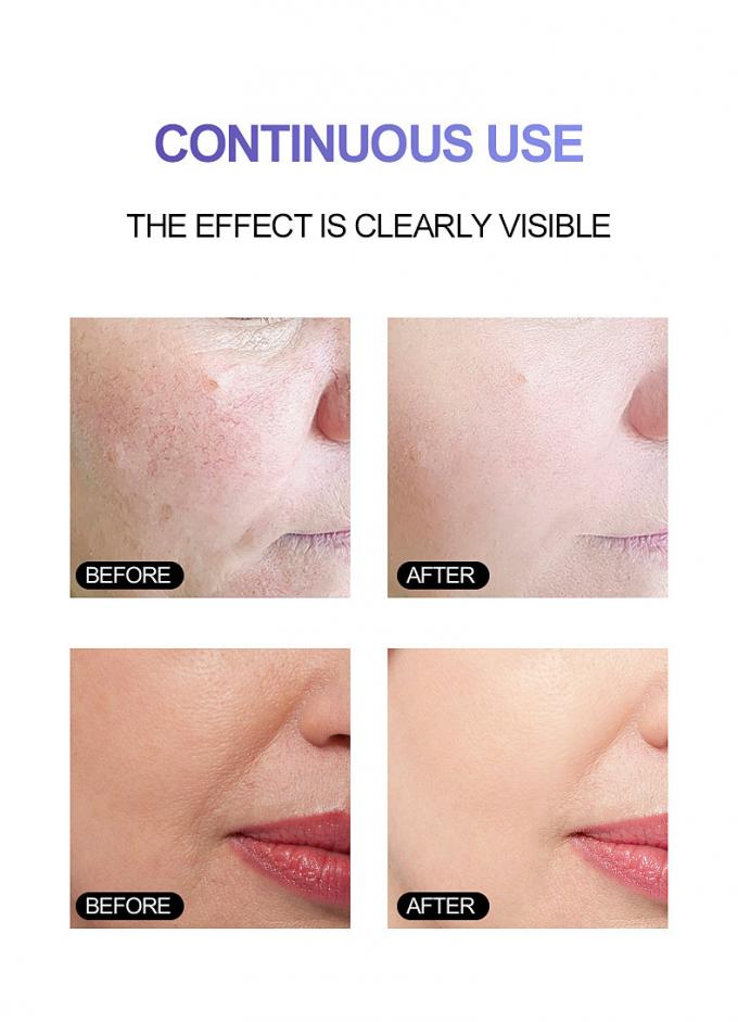 pele brilhante Rosacea avançado 1 da vermelhidão pura do soro 100% da cara da essência 30ml